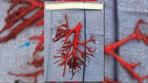 Often when related to lung cancer, blood or clots in coughed up mucus can be persistent and regular, and may accompany other symptoms. Man S Extreme Bout Of Coughing Forces Out Blood Clot In Shape Of Lung Newscentermaine Com