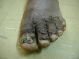 Tuberculosis cutis indurativa (erythema induratum bazin): Cutaneous Tuberculosis Cutaneous Tb Relatively Uncommon Form Of