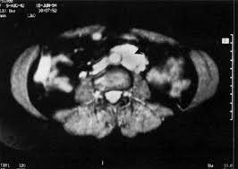 To get back to the main page, select lesson from the menu bar at the top of this application (note: Primary Leiomyosarcoma Of The Abdominal Aorta Journal Of Vascular Surgery