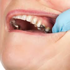 Black Teeth The Causes And Treatments The Dental Centre London
