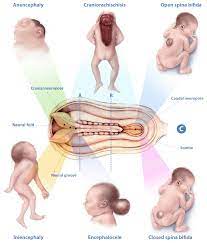 The appearance in the intimate area of specific secretions, accompanied by an unpleasant. 4 2 Congenital Malformations Of The Nervous System Neural Tube Defects Cdc