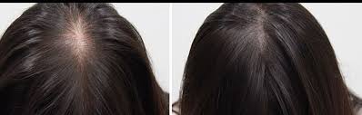 Pin On Hair Loss