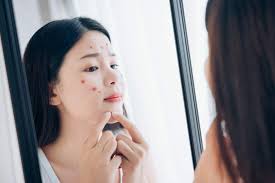 Jerawat Jenis Penyebab Obat Terapi Dll Hello Sehat