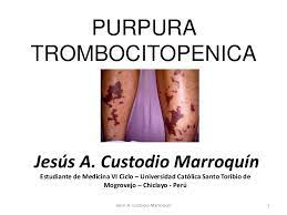 La trombocitopenia inmunitaria es un trastorno que puede llevar a que se presenten moretones y sangrado fácil o excesivo. Purpura Trombocitopenica