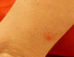 Image result for Tarantula Bite