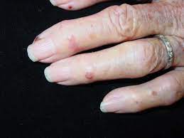 Bullous Disease Of Dialysis الداء الفقاعي الناتج عن التحال الدموي