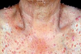 Neurofibromatosis type 1 (nf1) is a multisystem genetic disorder that commonly is associated with cutaneous, neurologic, and orthopedic manifestations. Neurofibromatosis Gponline