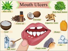 7 Home Remedy For Mouth Ulcer In Children During Summers Mouth Ulcers Mouth Sores Ulcer Remedies Mouth