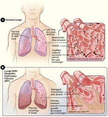 Ordinarily, your body generates just the right amount of tissue to repair damage. Pulmonary Fibrosis Physiopedia