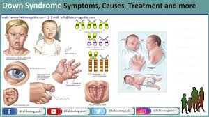 Down Syndrome: Causes, Symptoms, and Supportive Care