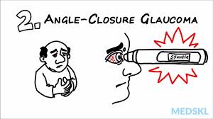 Aacg affects 4 in 1000 people aged over 40 years old and can cause. File Angle Closure Glaucoma Slide To Acute Visual Loss Webm Wikimedia Commons