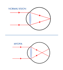 Image result for Myopia