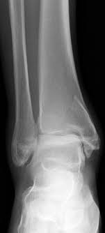 Weber a variant lateral malleolus fractures present another clinical dilemma. Ankle Fractures Trauma Orthobullets