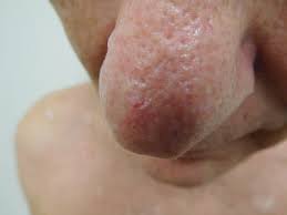 Search only for basel cell carcinoma Cureus Red Dot Basal Cell Carcinoma Report Of Cases And Review Of This Unique Presentation Of Basal Cell Carcinoma