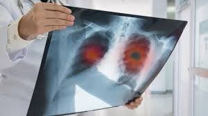 Symptoms and findings of endobronchial growth cough, hemoptysis, pain, wheezing, poststenotic pneumonia, dyspnea, stridor symptoms and findings of.peripheral lung cancer. Constipation And Back Pain Can Be Symptoms Of Lung Cancer World Today News