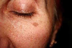 See more ideas about sun damaged skin, skin, premature aging. Reversing Sun Damaged Skin Dermatology In Keller Tx