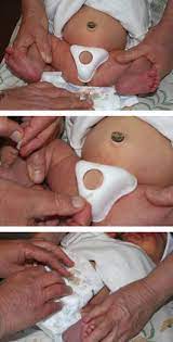 Bobbi Shield Helps Baby Boys Recover After Circumcision Medgadget