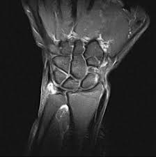 Gross anatomy the tfcc is located on the ulnar aspect of the wrist joint. Arthroskopische Chirurgie Des Handgelenkes Sciencedirect