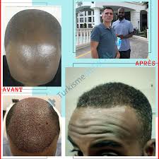 1450 €, découvrez nos meilleures cliniques et docteurs basés sur des avis certifiés. Resultat Greffe De Cheveux Afro Avec Turkisme Medical Greffe De Cheveux Implant Capillaire Implant Cheveux