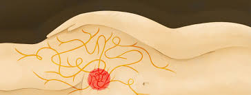 Does Endometriosis Cause Hip Pain