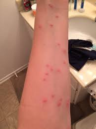 Image result for bedbugs bites