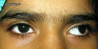 Squint Symptoms Causes And Treatments Eye Treatment Uneven Eyes Eye Surgery