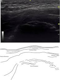 Image result for Pubic Apophysitis