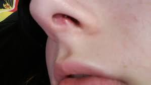 Vor allem im rahmen trocknet die nase aus, ist das meist recht unangenehm. Septum Nach 2 Wochen Noch Immer Geschwollen Piercing Nase