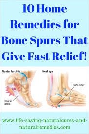 10 Sure Fire Ways To Get Rid Of Bone Spurs Naturally At Home Cold Home Remedies Home Remedies For Warts Bone Spurs