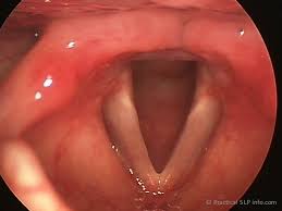 Image result for Reflux Laryngitis