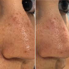 It has 1 million members and hosts more than 1,000 new posts per day, ranging from discussions… Misc I Did The Sebaceous Filaments Thing Skincareaddiction