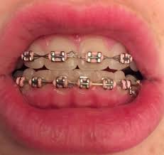 Kimmiecla Pink Braces Cute Braces Cute Braces Colors
