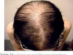 Chemotherapy can be a distressing experience in itself, and hair loss only exacerbates that. Case Of Permanent Chemotherapy Induced Alopecia With Response To Topical Minoxidil Semantic Scholar