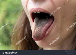 Image result for brown tongue symptoms
