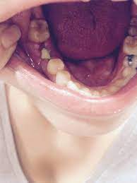 Maybe you would like to learn more about one of these? 14 Days After Dental Molar Extraction And Bone Graft And Still Having Intense Pain Abx Entire Time Now Photo