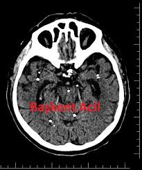 Bir Bilmecem Var Acilciler Nedir Bu Beyaz Benekler Acilci Net