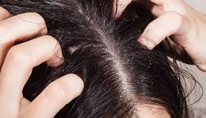 The Best Natural Shampoo For Dry Scalp Dandruff 100 Pure