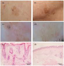 Image result for Solar Lentigo