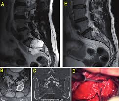 Abb 2 Mrt Ct Und Op Bilder Zu Fall 2 A Praoperatives Mrt Der Download Scientific Diagram