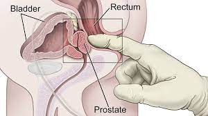 Skill Checkup: Digital Rectal Examination