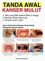 Kemudian doktor akan melakukan pemeriksaan fizikal di dalam mulut untuk mengenal pasti tanda kanser sepeti ulser berlarutan. Viral Johor Info Kesihatan Kanser Mulut Adalah Satu Facebook