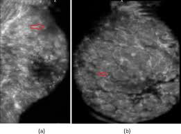 Ultrasound is inherently operator dependent, and breast ultrasound even more so; Breast Cancer Detection In Automated 3d Breast Ultrasound Using Iso Contours And Cascaded Rusboosts Sciencedirect