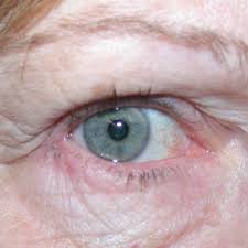While examining me, she says 'i'm going to flip your top eyelid for a second.' and does it (the first time i've ever experienced this). Granulated Eyelids Blepharitis Eyelid Inflammation