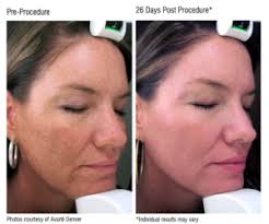 Image result for Melasma