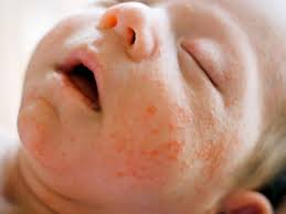 Berbekalkan pengalaman mommynis dengan yusuf juga sebelum ni, mommynis compile tips untuk anak 1. 6 Jenis Alergi Pada Kulit Bayi Wajib Untuk Diketahui