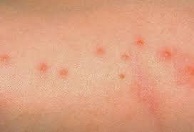 bedbugs leave red itchy bites on the skin usually in rows bed bug bites bed bugs bed bugs pictures