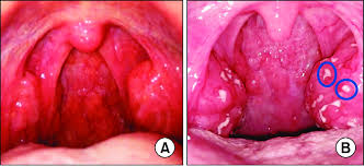 Image result for Pharyngitis