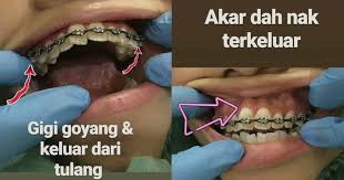 Berapa harga pendakap gigi di klinik kerajaan? Gigi Mula Goyang Alami Infeksi Gara Gara Memakai Fake Braces Demi Kejar Trend