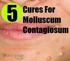 Once dried, the paste will form a clear seal, similar to a liquid bandage, over the lesions. 17 Molluscum Ideas Molluscum Treatment Molloscum Contagiosum Remedies