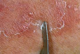 Ringworm Pictures What A Ringworm Rash Looks Like Sometimes it is just a red, itchy rash. ringworm pictures what a ringworm rash